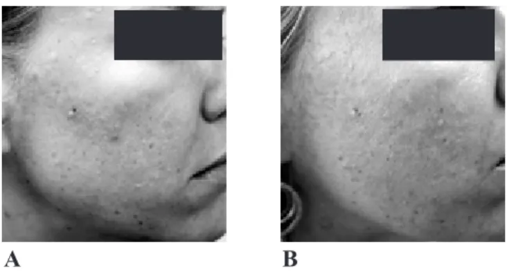 Figure  1:    Clinical  example  of  ALA-PDT  for  the  treatment of acne vulgaris. Before treatment (A) and  after 2 treatments (B).
