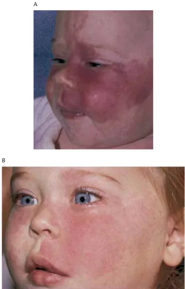 Figure 2.19 (A) Initial appearance of extensive port-wine stain (PWS) on a 10-week-old girl