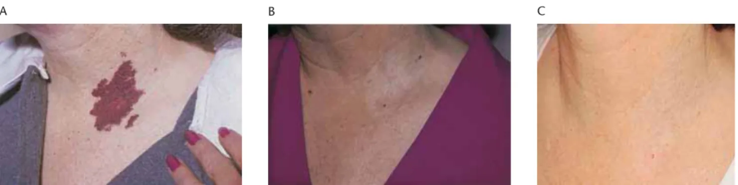 Figure 2.20 Port-wine stain on left anterior chest of 44-year-old woman. (A) Before treatment