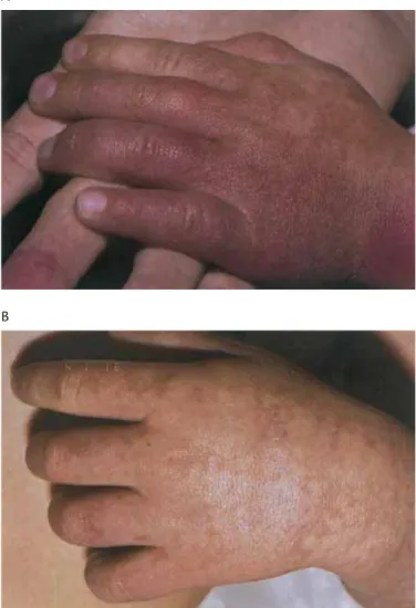 Figure 2.28 Extensive port-wine stain (PWS) of left hand, forearm, and chest of 18-month-old boy