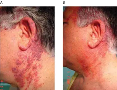 Figure 2.36 Long-standing PWS before and 1 month after 4- 4-monthly treatments with a long-pulse Nd : YAG laser using a  7-mm-diameter handpiece with a ﬂuence of 60–65 J/cm 2 at 10–15 ms pulse duration