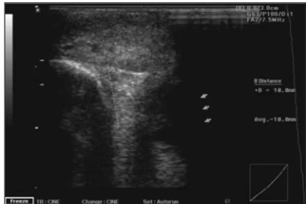 Figure 7. Color-Doppler ultrasonographical aspect of the internal orbital angle hemangioma, with a  reduc-tion of vascular signal after treatment (same patient as in Figure 1)