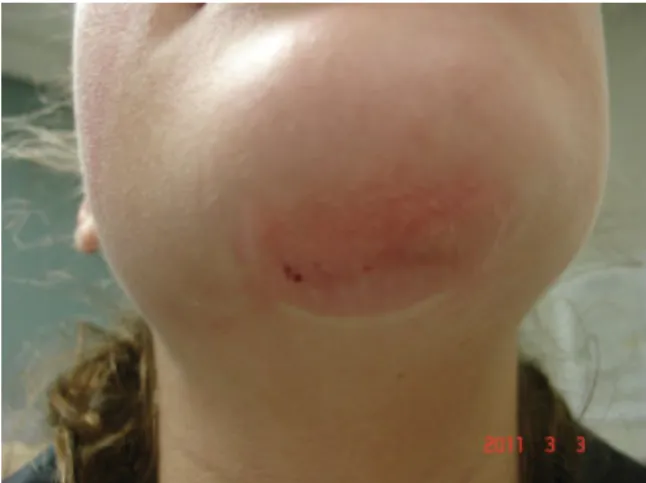 Figure 3 Normal post-Fraxel urticaria.