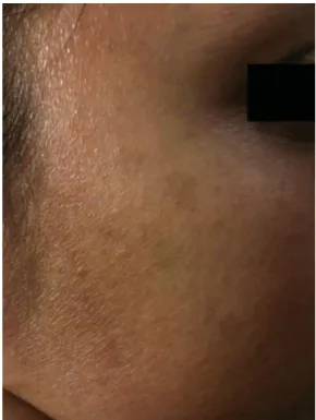 Figure 6 Close-up of postin ﬂammatory hyperpigmentation after ruby laser treatment.