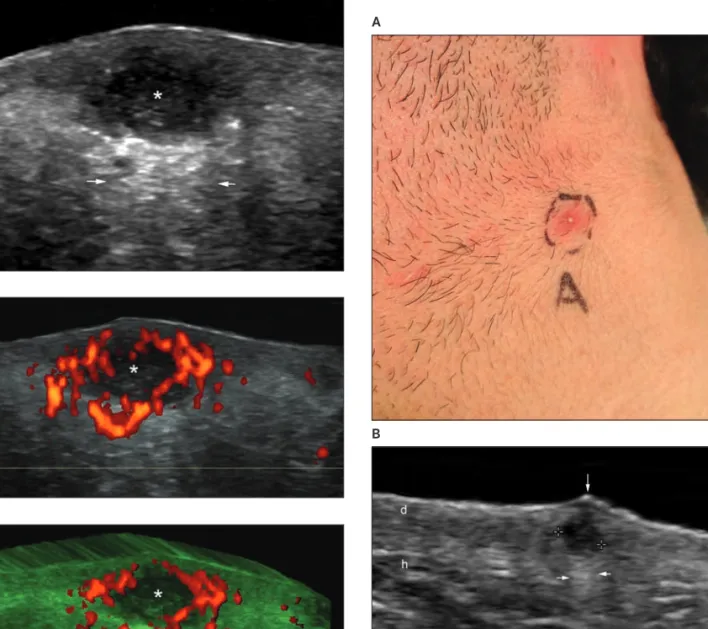 Figure 4. Enhanced vascularity around a pseudocyst in an 18-year-old female patient with acne vulgaris