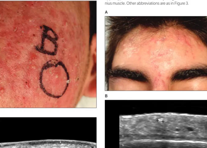 Figure 8. Clinical papule-pustule: sonographic fistulas in a 17-year-old male patient with acne vulgaris