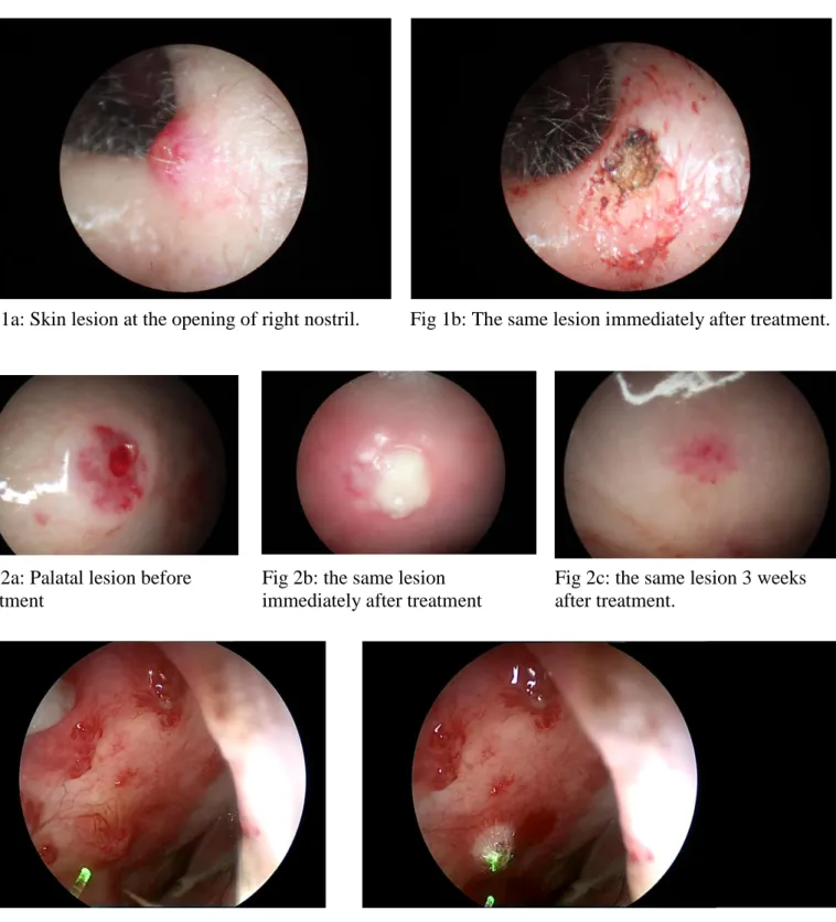 Fig 2a: Palatal lesion before  treatment 