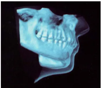 Figure 12: Levoy example.  Figure taken from [Levoy 1990]. 