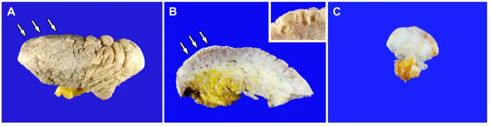 Figure 1: Histopathological findings of vulvar lymphangioma circumscriptum. A. The upper dermis shows irregularly shaped, cystically dilated lumina