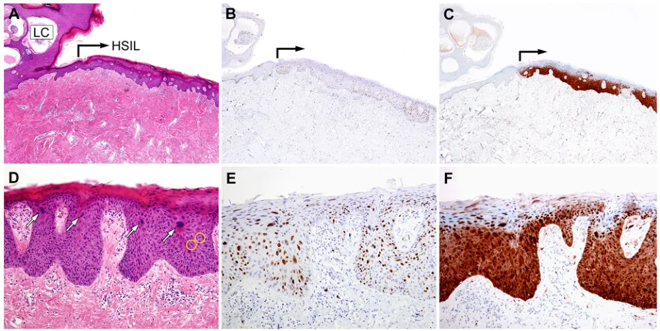 Figure 3: Histopathological and immunohistochemical findings of Case 1. A. The right upper corner shows cisterns of lymphatic channels, partially enclosed by irregularly growing epidermis (LC)