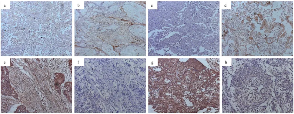Figure 1: Expression of miRNA-200a and HGF in NSCLC (magnification ×200). b.expression in stromal fibroblasts; a