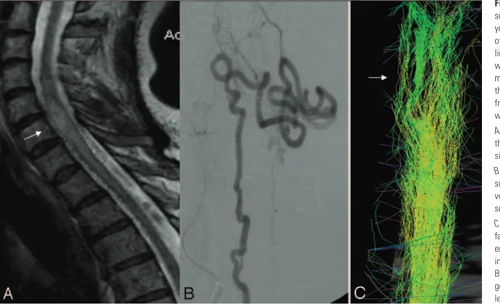 Fig 1. Venous congestion of the spinal cord andseparated tracts (patient 1, DTI25d). This 57-year-old woman presented with a 2-year historyof progressive paresthesia in the bilateral lowerlimbs, followed by further development of legweakness and sphincter 