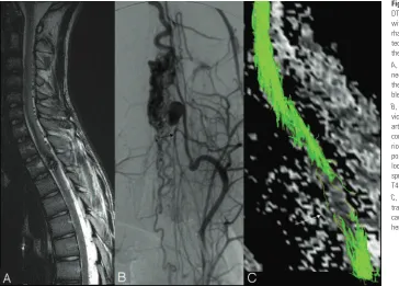 Fig 6. Hemorrhage in the spinal cord (patient 7,