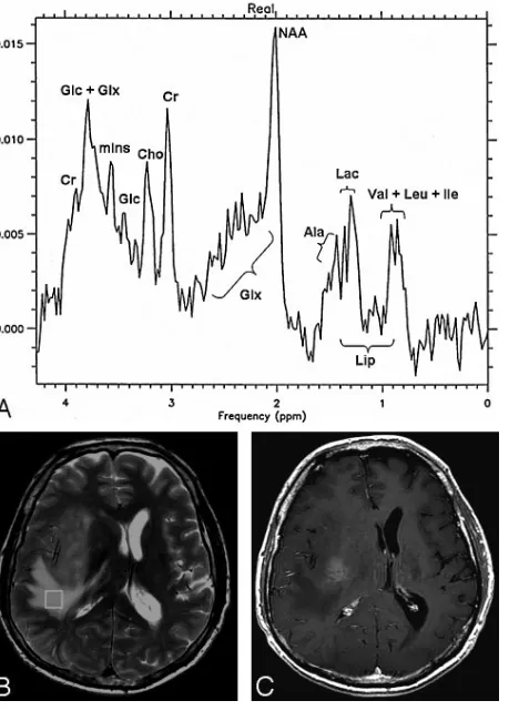 Table 1: Ratios of the main metabolites detected in the cerebraledema of 13 patients*