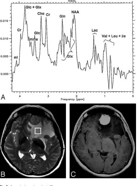 Fig 3. A meningioma in patient 12.