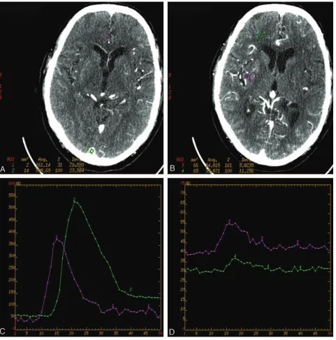 Fig 1. The regions of interest (ROI) for an arterial input (ACA) and venous output (sagittal sinus) (A) and for gray matter and white matter (B)