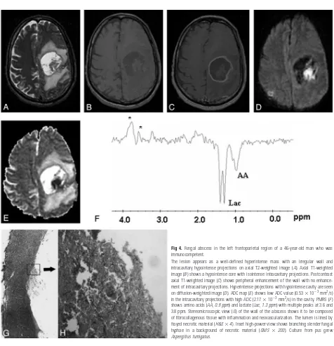 Fig 4. Fungal abscess in the left frontoparietal region of a 46-year-old man who was