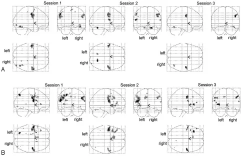 Fig 1. Glass-brain maps of the random-effects analysis. For labeling of the activated areas see Table 1