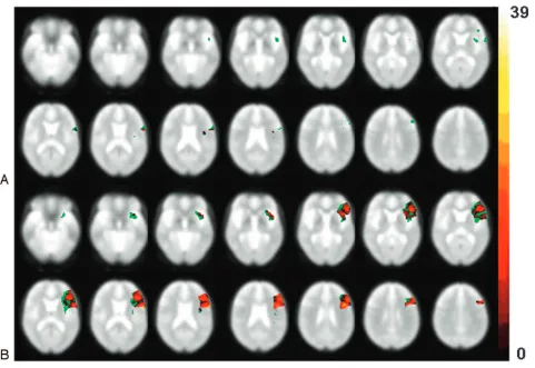 Fig 2. Number of subjects with activation in the opercular part, triangular part, and the insula of the left hemisphere