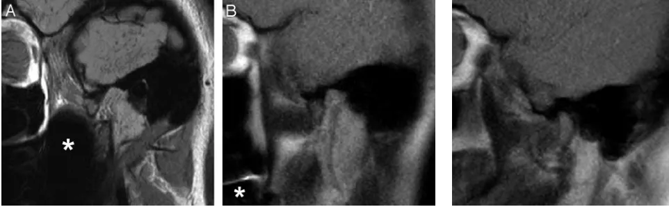 Fig 3. A, Static sagittal oblique proton-attenuation image of the TMJ. B, Single frame from a sagittal HASTE imagingseries of the same TMJ