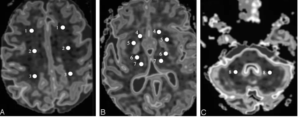 Fig 1. Apositions are represented by 4 for the caudate heads, 5 for the putamina, 6 for the posterior internal capsules, and 7 for the thalami., Regions of interest 1, 2, and 3 represent measurements made in the anterior, central, and posterior WM in the c