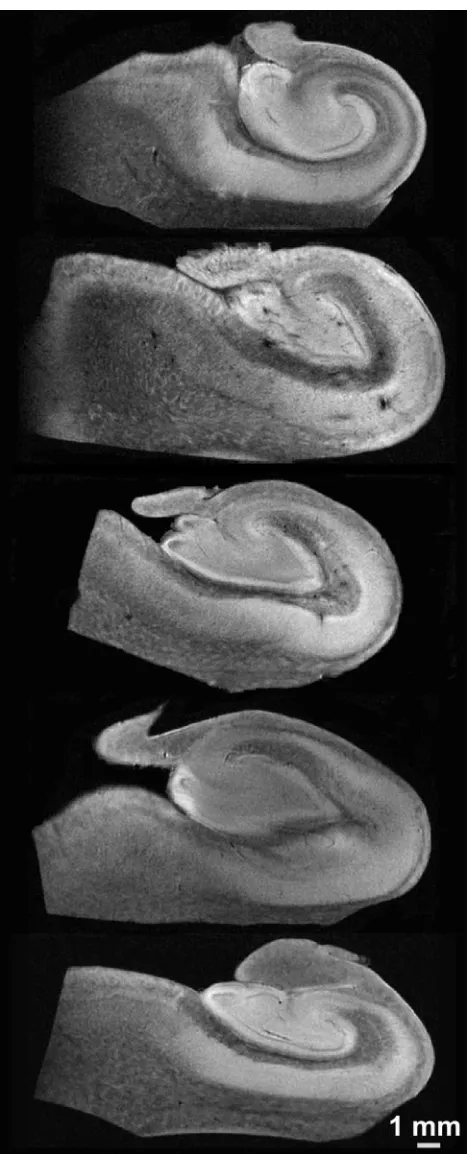Fig 3. Representative 60-s/mm�m in-plane resolution diffusion-weighted images (b � 12502) from each of the 5 human hippocampus autopsy specimens
