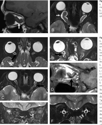 Fig 1. Optic glioma.