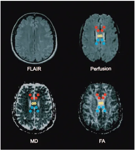 Fig 1. Fluid-attenuated inversion recovery image, perfusion image, MD map, and FA mapshowing placement of ROIs within the genu (red), central body (yellow), and splenium (blue)of the corpus callosum.