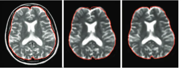 Fig 1. Geometric distortions inherent in echo-a pulsed gradient SE-EPI experiment, after rigid(planar imaging (EPI), evident from the compar-ison between a fast spin-echo (FSE) T2-weighted image (left) and the b � 0 image ofmiddle) and nonlinear transforma