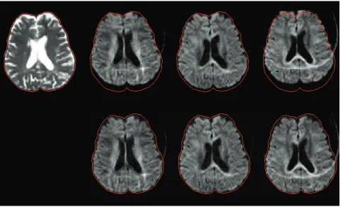 Fig 2. Geometric distortions caused by eddy currents. A non–diffusion-weighted image (before (on the other images to show the degree of distortion