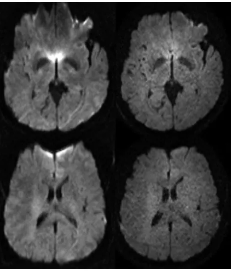 Fig 3. Diffusion-weighted MR imaging at 3T: the left column shows 2 transverse sectionsacquired without sensitivity encoding (SENSE), whereas the right column shows the samesections acquired with a SENSE factor R � 3