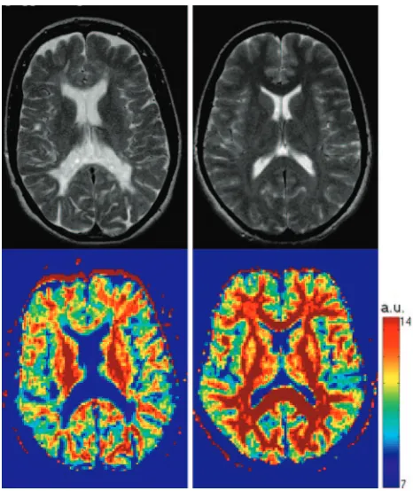 Fig 4. T2-weighted images (T2-weighted visible lesions and the normal appearing white matter are characterized byrowtop row) and q-space probability for zero displacement (bottom) are shown for a healthy control (right) and a multiple sclerosis patient (le