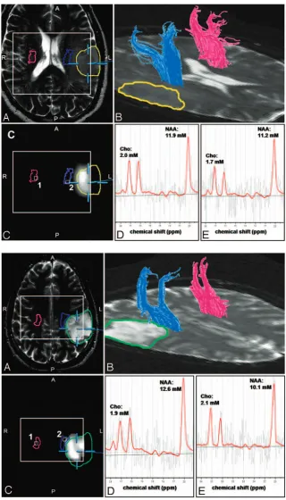 Fig 1. Results of the fiber-tracking procedure of the DTIipsilateral (Bcoregistered with a segmented metabolic Cho/NAA map(tracts, the tumor segmented manually by a neurosurgeron((data and the spectral analysis of the MRSI data for apatient having no senso