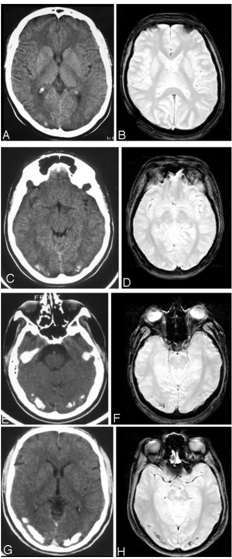 Fig 1. Examples of visual rating of the extent of occipital calcifications on CT (moderate (scoresevere calcifications are appreciable as areas of low signal intensity in T2*-weightedHA, C, E, andG) and corresponding T2*-weighted gradient-echo images witho