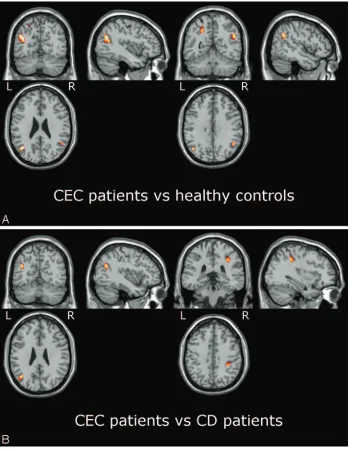 Table 4: Coordinates of the clusters of reduced MTR in the patients with CEC versus patients with CD