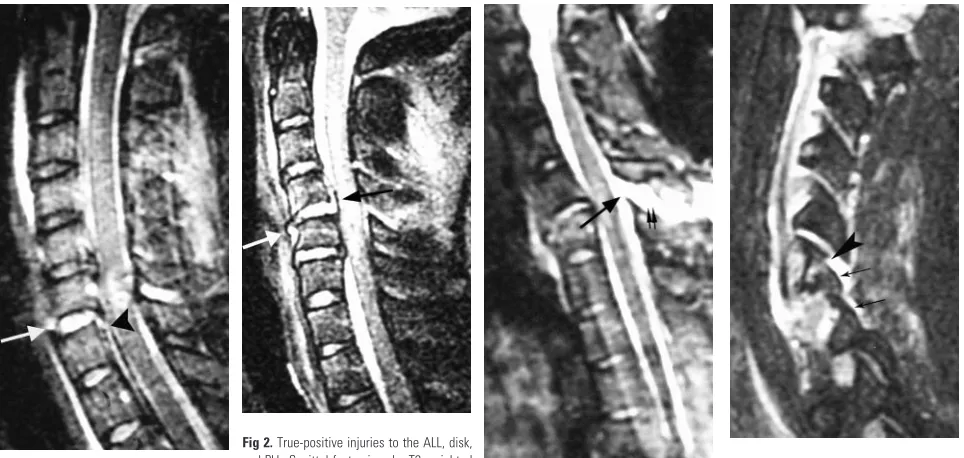 Fig 2. True-positive injuries to the ALL, disk,and PLL. Sagittal fast spin-echo T2-weightedimage shows elevation of the ALL (whitearrow), disruption of the intervertebral disk,and elevation of the PLL at C4–5 (blackarrow)