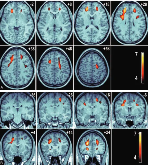 Fig 2., A series of axial images at 10-mm intervals showing T-scores (in color) superimposed over a representative high-resolution anatomic magnetization-prepared rapid acquisitionBvoxels connect these regions to the anterior thalamus (sections �28 to, A s