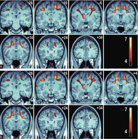 Fig 3.� �BBilateral cluster of voxels are present in the frontal and parietal lobes (sections �28 to, A series of coronal sections at 10-mm intervals showing the connection between the frontal and parietal significant voxels with the anterior thalamus (sec