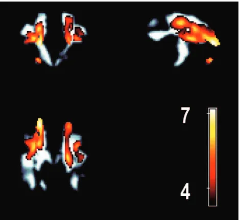 Fig 4. A maximum intensity projection image displaying the age-related FA changessuperimposed over the significant regions of FA associated with altered performance inexecutive function task