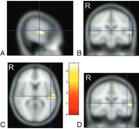 Fig 2. Cross-sections through the left superior temporal gyrus showing the focus of white
