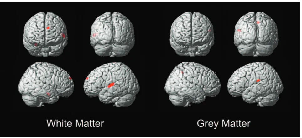 Fig 5. Deaf versus hearing asymmetry VBM of white matter and gray matter. T threshold at T � 5.7, extent threshold at 200 voxels.
