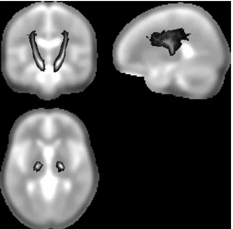 Fig 1. The pyramidal tract (PYT) probability map. The gray-scale overlay indicates theprobability of a voxel being part of the PYT.