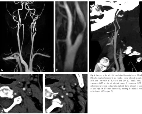 Fig 4. Stenosis of the left ICA. Local signal intensity loss at CE-MRAable with TOF-MRA ((A) with distal enhancement, but residual signal intensity is detect-B: TOF-MIP) and CTA (C, “scout” MIP; D,transverse MPR at site of minimal lumen; E, transverse MPR 