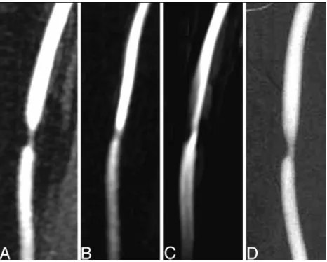 Fig 1. Sample carotid stenosis images from contrast-enhanced MRA (A), PC-VIPR MRA (B),3D Time of Flight MRA (C), and DSA (D).