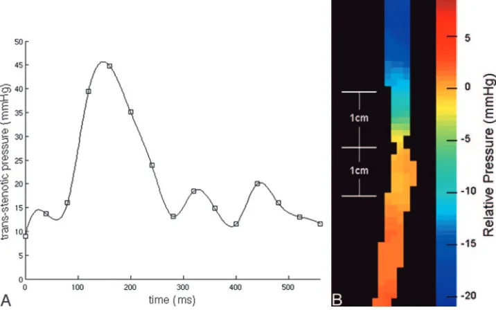 Fig 2. Sample dynamic pressure curve (A) and average pressure color map (B) from the PC-VIPR technique obtained across the carotid artery stenosis.