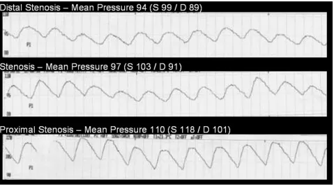 Fig 6. Plot showing that pressure changes are identified at all of the observed degrees ofstenosis with weak correlation between the degree of stenosis and the pressure gradientdue to a high variability in pressure changes.