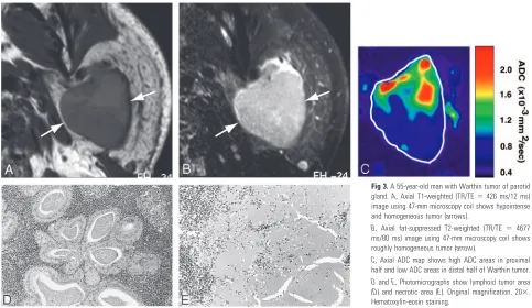 Fig 3. A 55-year-old man with Warthin tumor of parotid