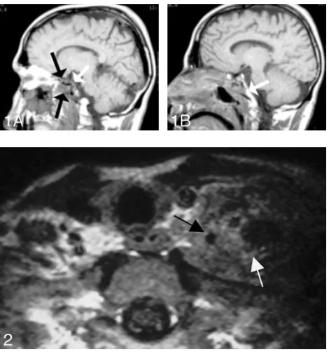 Fig 3. Prevertebral muscular infiltration.