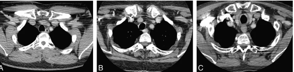 Fig 4. Multidetector row CT evaluation of extracranial head and neck. Transverse CT images of fixed current (noise index 10 (A) and z-axis automatic exposure control (AEC) with noise index 8 (B) andC) at the level of the shoulders, illustrating suboptimal subjective noise and diagnostic acceptability.