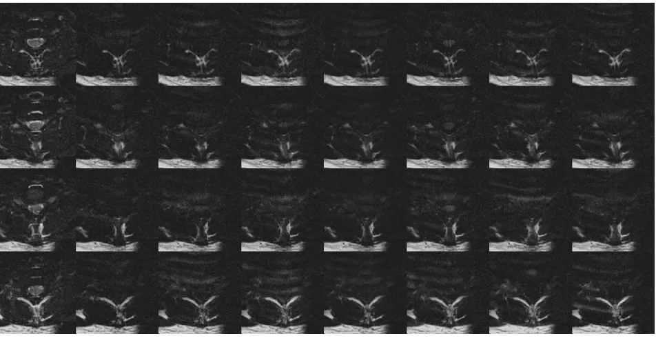 Fig 2. DTI data covering 1 vertebral body (4 sections) acquired without restriction to the quiescence of spinal cord motion